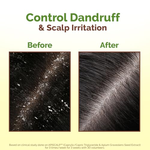 Mamaearth Lemon Anti-Dandruff Hair Oil