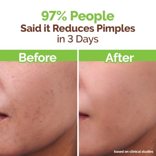 Mamaearth Tea Tree Pimple Control