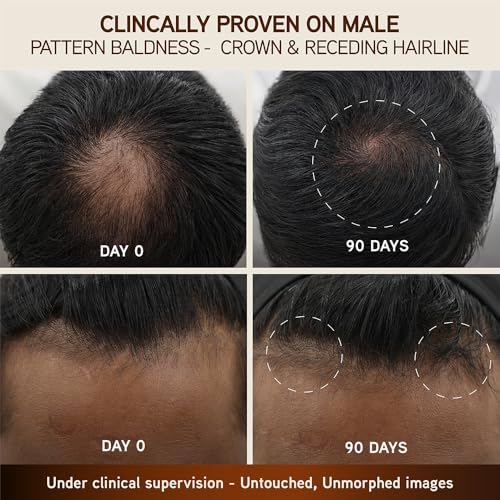 Indulekha Bringha Hair Growth Treatment